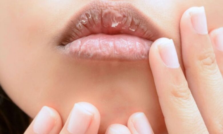 Cara alami atasi bibir kering dan juga pecah-pecah agar tampil percaya diri
